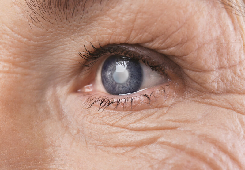 cataracts 101 symptoms causes treatment